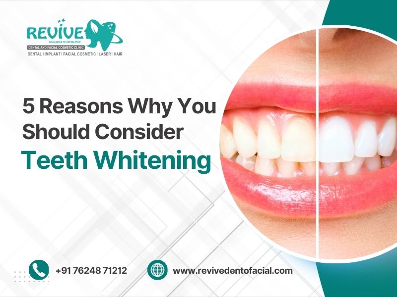 5 Reasons Why You Should Consider Teeth Whitening