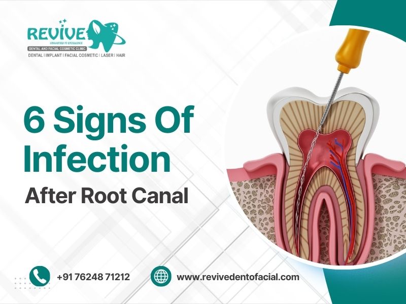 6 Warning Signs of Infection After a Root Canal