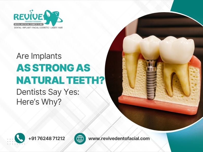 Are Implants as Strong as Natural Teeth? Dentists Say Yes: Here’s Why