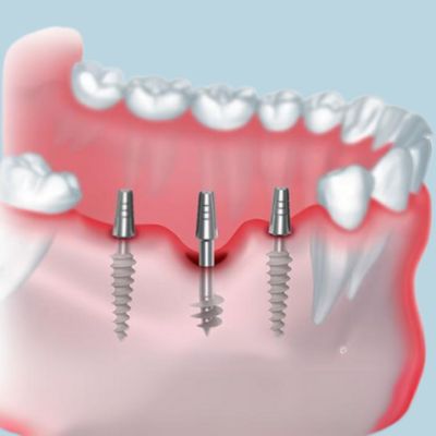 Basal Implants in rajajinagar Bangalore