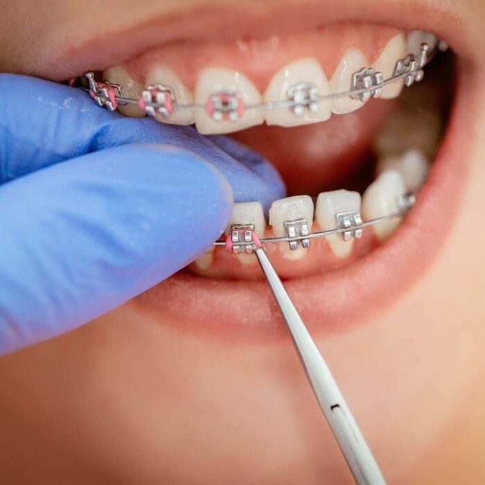 braces treatment in rajajinagar