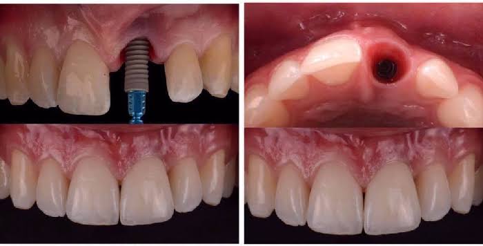 dental implants in rajajinagar Bangalore