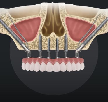 Basal Implants