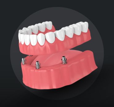 Implant Supported Dentures