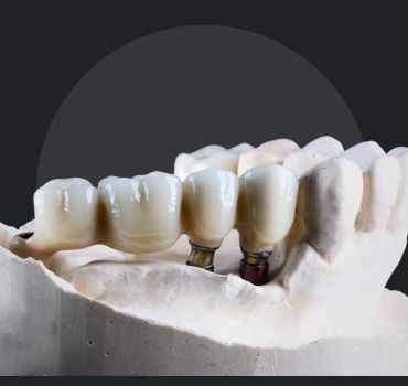 Multiple Teeth Implants