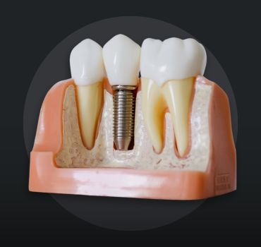 Single Tooth Implant